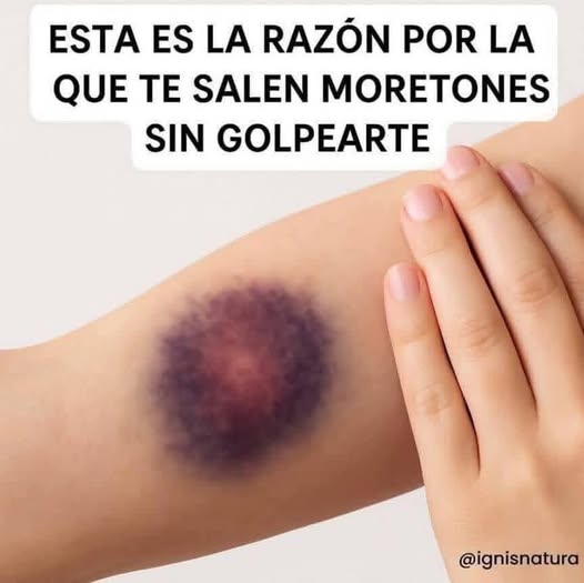 ESTA ES LA RAZÓN POR LA QUE TE SALEN MORETONES SIN GOLPEARTE